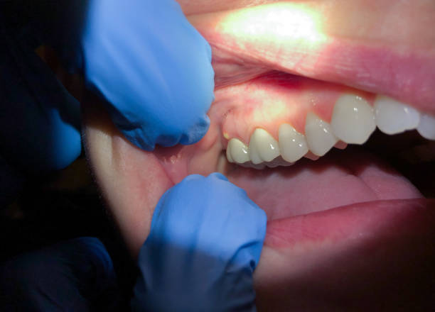 Best Emergency Dental Surgery in Gautier, MS